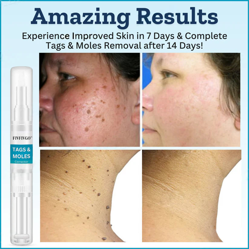 Fivfivgo™ Tags & Moles Remover (FACK OF 2)
