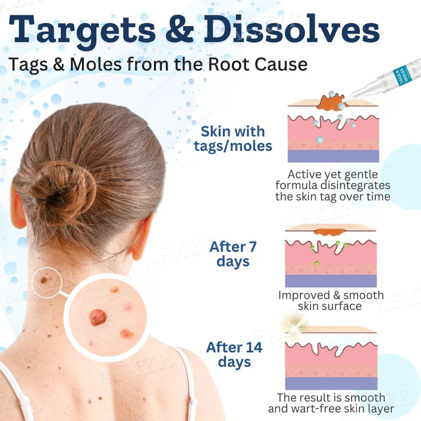 Fivfivgo™ Tags & Moles Remover (FACK OF 2)